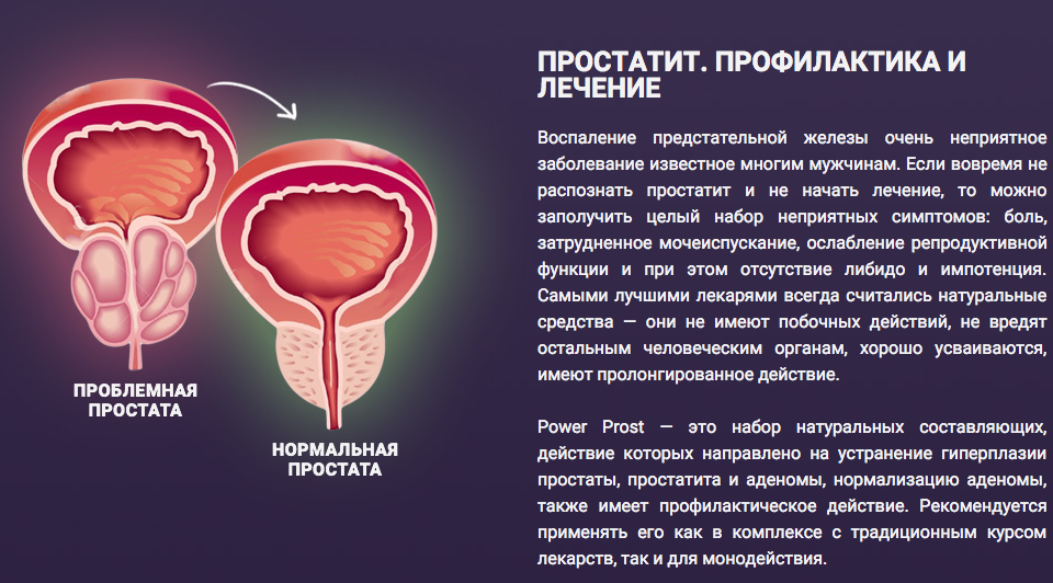 Железы у мужчин воспаления. Воспаление в предстательной железе.